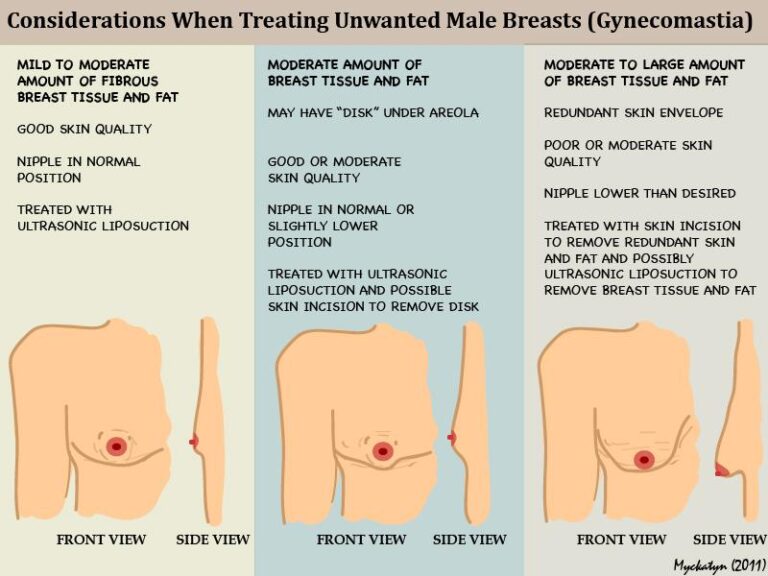 sexual-characteristics-gynecomastia